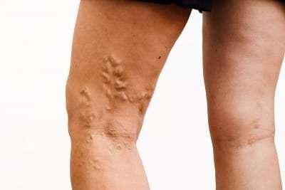 Are Varicose Veins Hereditary