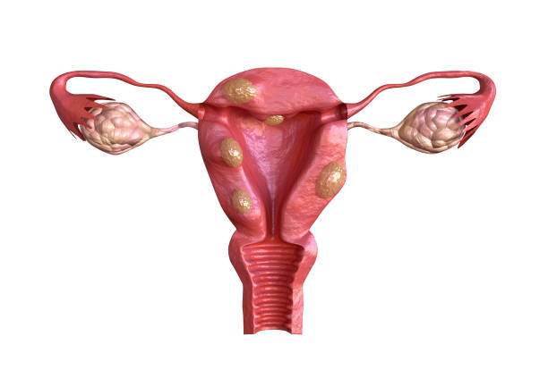 Uterine-Fibroid-Surgery-Cost-in-Pune