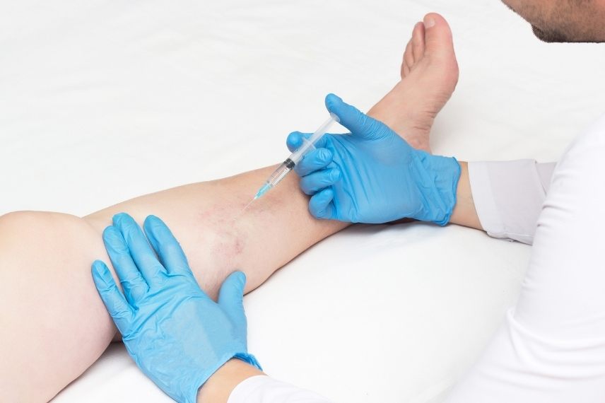 benefits-of-sclerotherapy-for-varicose-veins