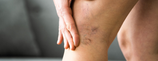 cause-of-varicose-veins