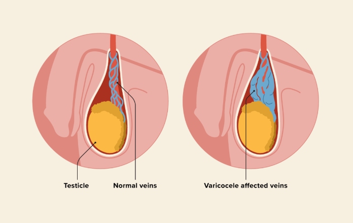 how-to-identify-varicocele