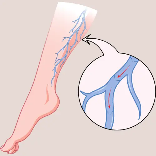 Signs-of-varicose-veins-1