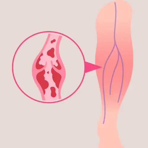 Signs-of-varicose-veins-4
