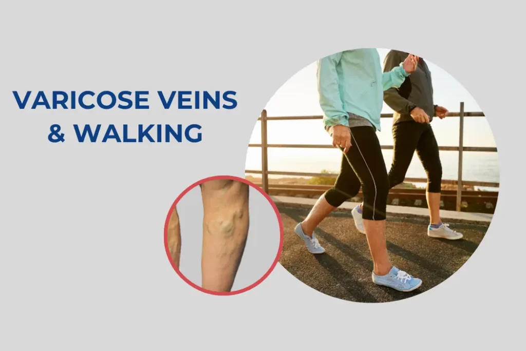 is-walking-good-for-varicose-veins