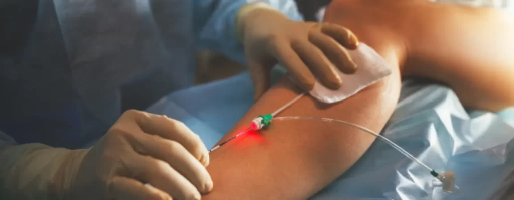 laser-treatment-for-varicose-veins