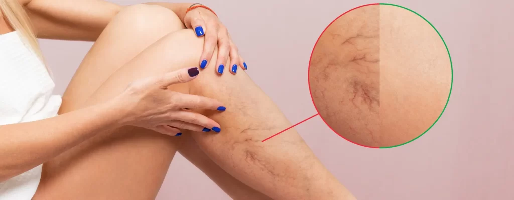 signs-of-varicose-veins