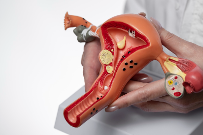 uterine-fibroids-treatment-without-surgery