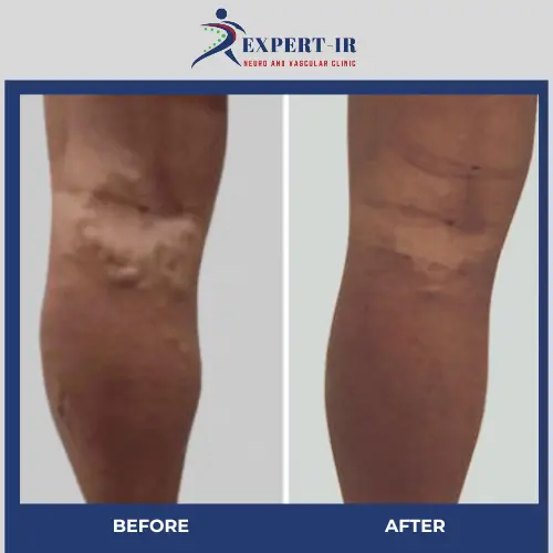 varicose veins before after results