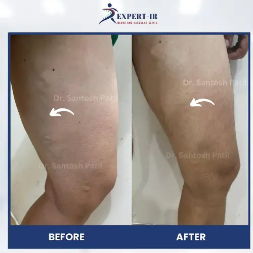 varicose veins before after