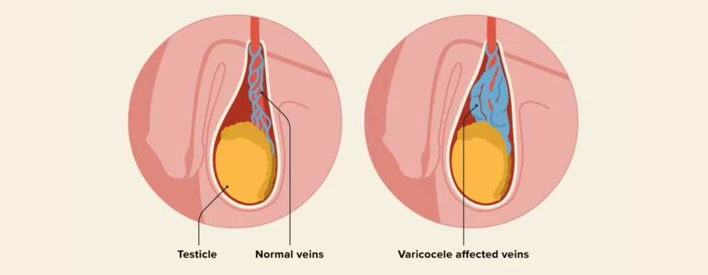 varicose-veins-in-scrotum