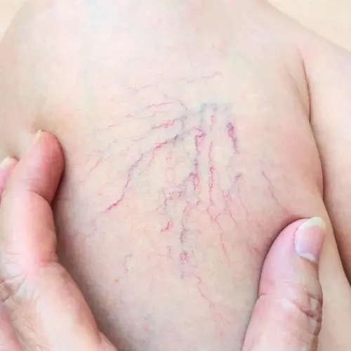 Spider-Veins