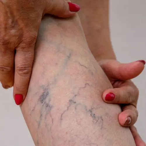 Varicose-Veins
