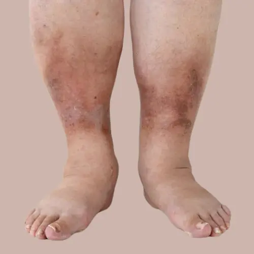 Leg Edema