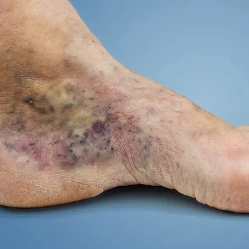 Healed-Venous-Ulcers