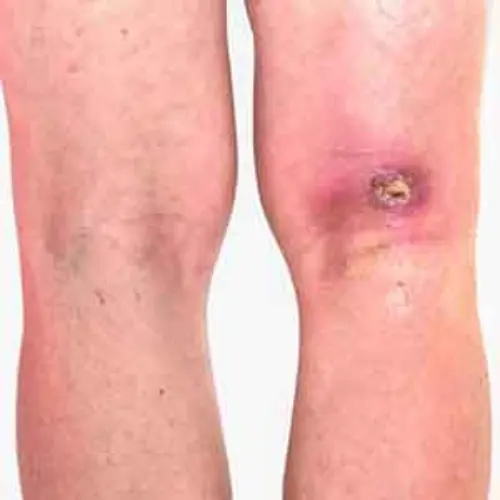 Active-Venous-Ulcers