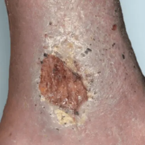 Recurrent-Ulcers