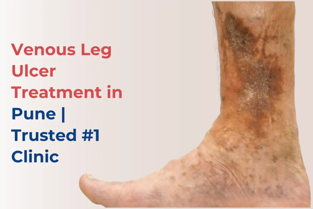 Best-venous-leg-ulcer-treatment-in-pune