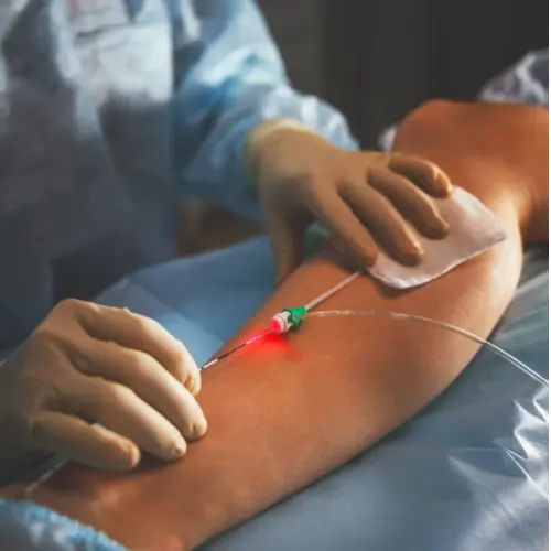 Endovenous Laser Treatment (EVLT)