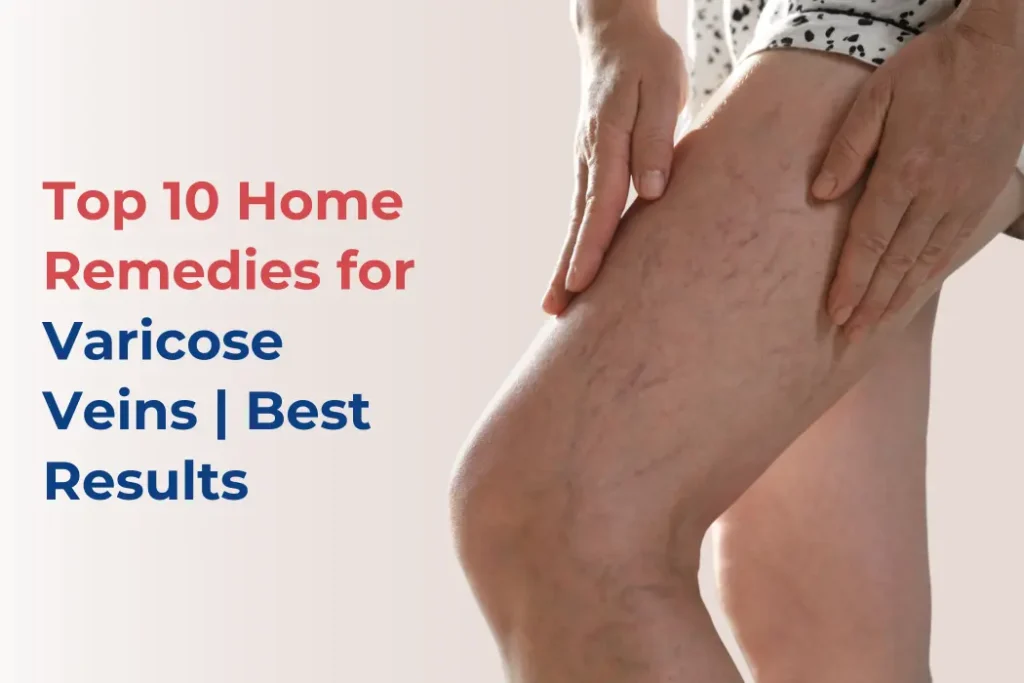 home-remedies-for-varicose-veins-top-10