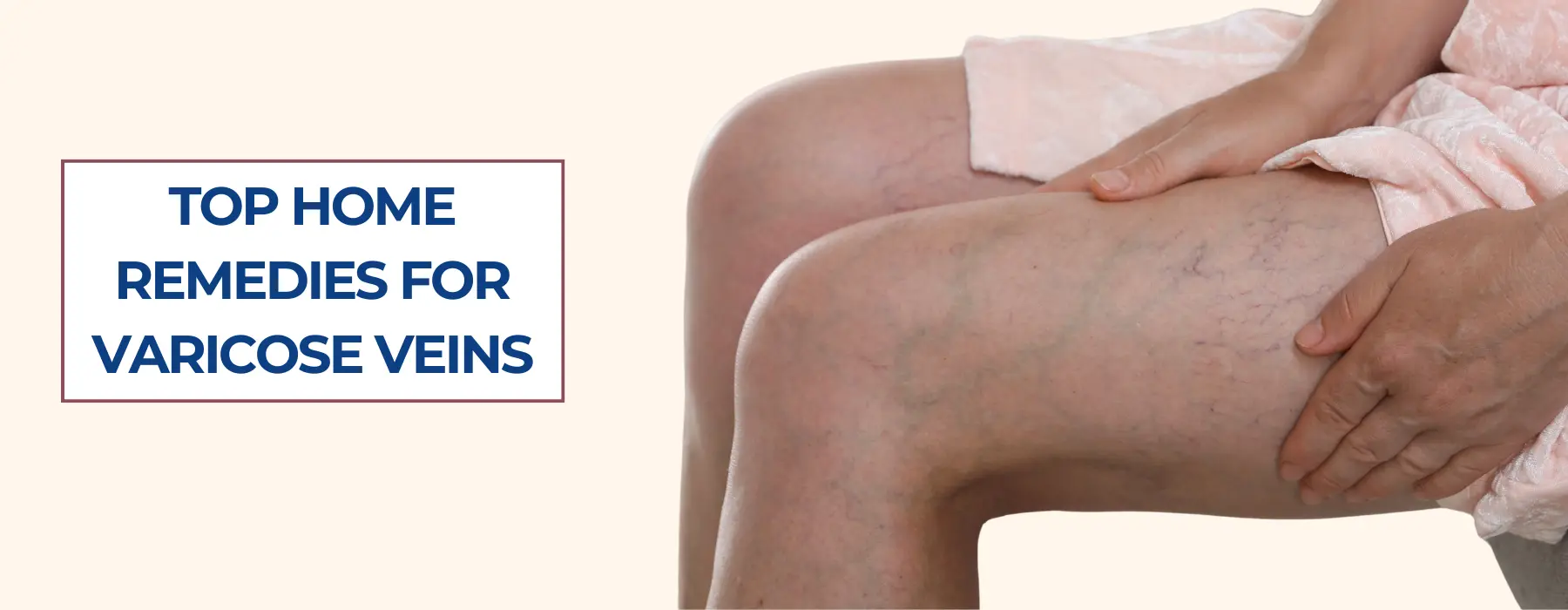 home-remedies-for-varicose-veins