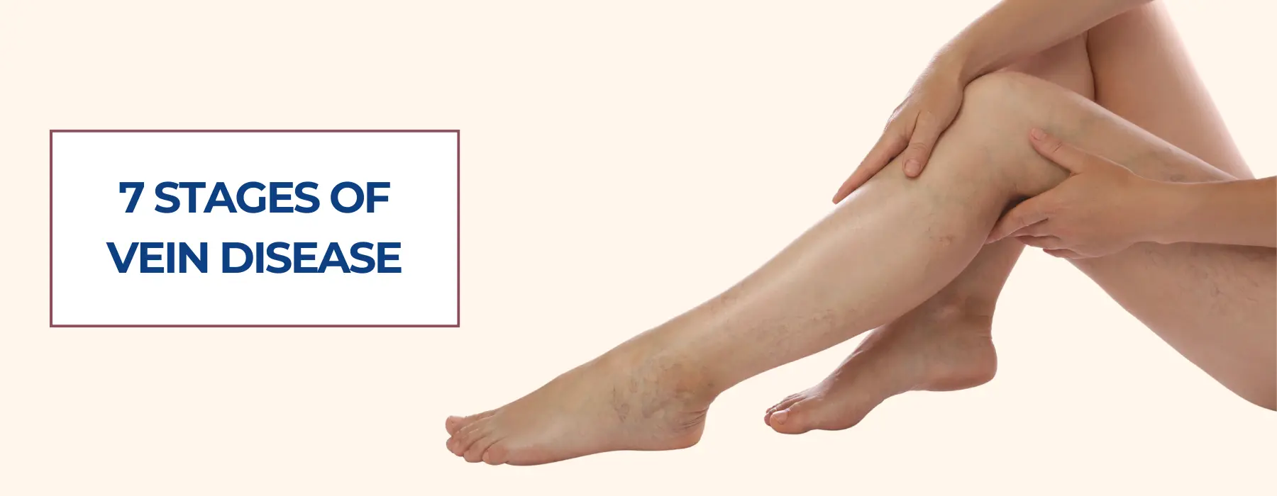stages-of-vein-disease