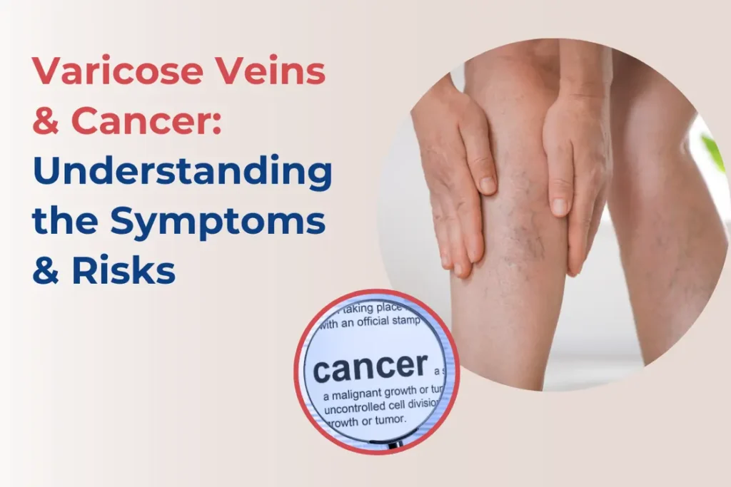 varicose-veins-and-cancer-relation
