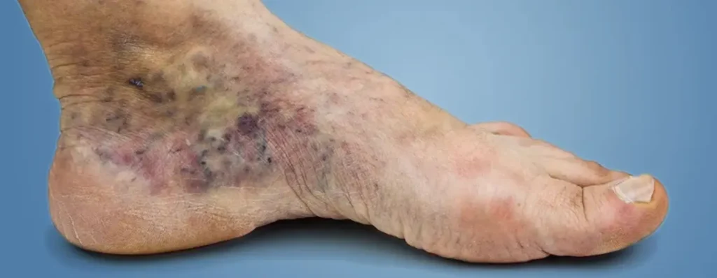 venous-leg-ulcer-treatment-in-pune