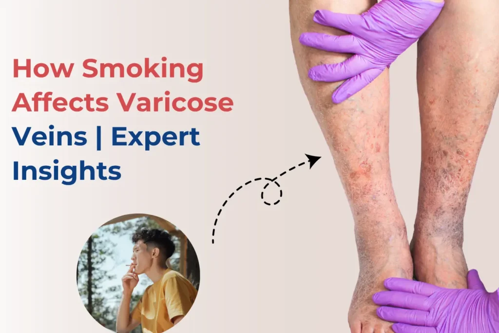 how-smoking-affects-varicose-veins-connection