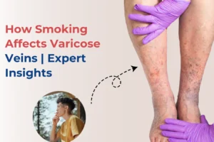 how-smoking-affects-varicose-veins-connection