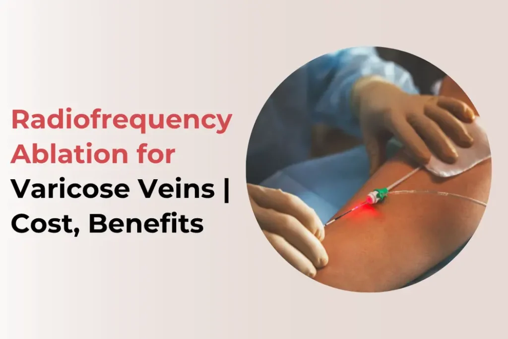 radiofrequency-ablation-for-varicose-veins-treatment
