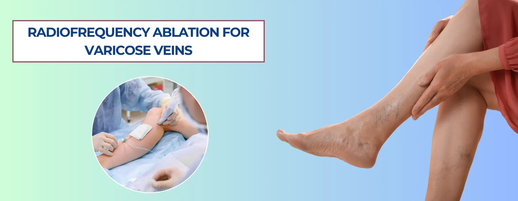 radiofrequency-ablation-for-varicose-veins