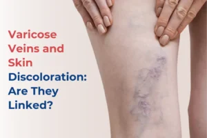 varicose-veins-and-skin-discoloration-connection