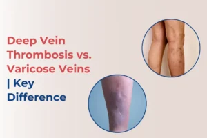 deep-vein-thrombosis-vs-varicose-veins-difference