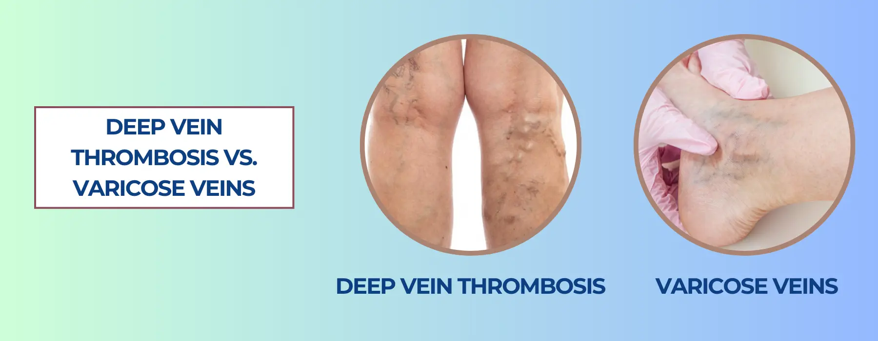deep-vein-thrombosis-vs-varicose-veins