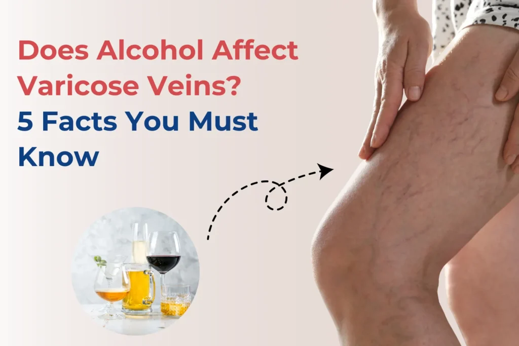 Alcohol and Varicose Veins