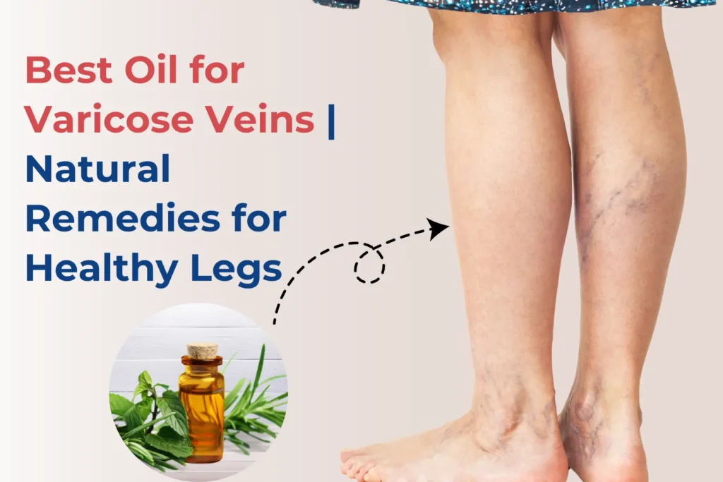 Oil for Varicose Veins