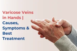 Varicose Veins in Hands - causes treatment
