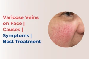 Varicose Veins on Face causes treatment