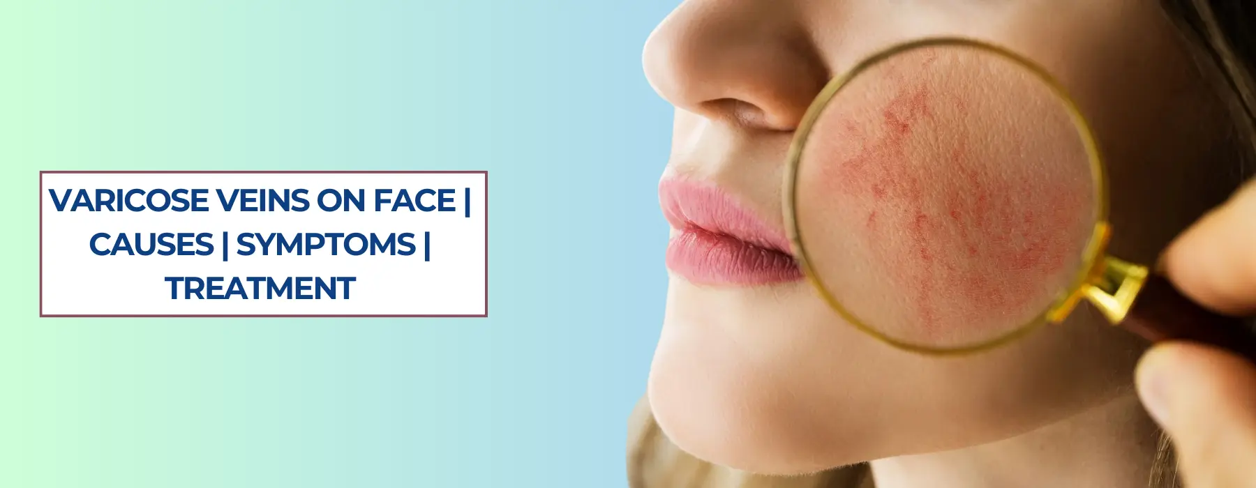 Varicose Veins on Face