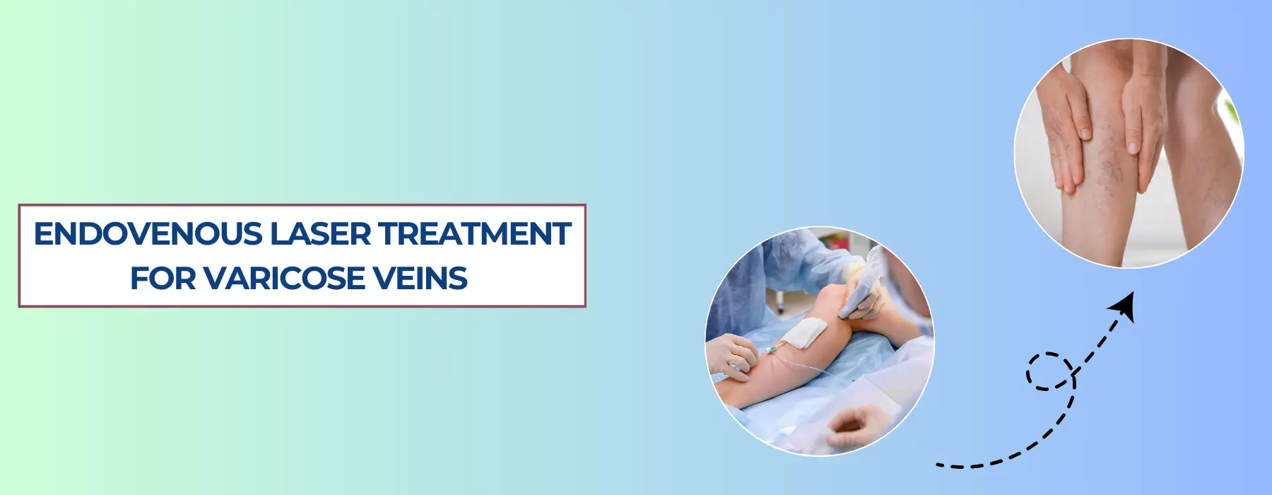 endovenous-laser-treatment-for-varicose-veins