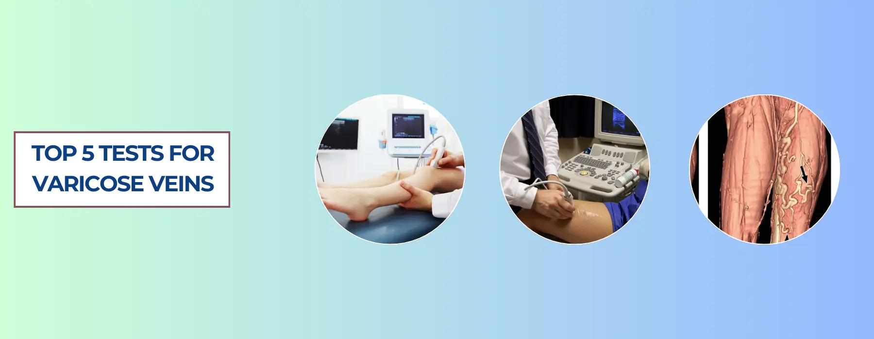 5 Tests for Varicose Veins