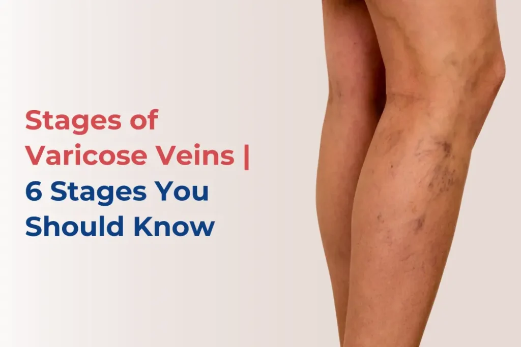 6 Stages of Varicose Veins