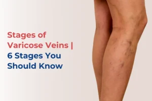 6 Stages of Varicose Veins