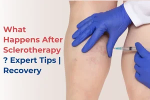 Sclerotherapy
