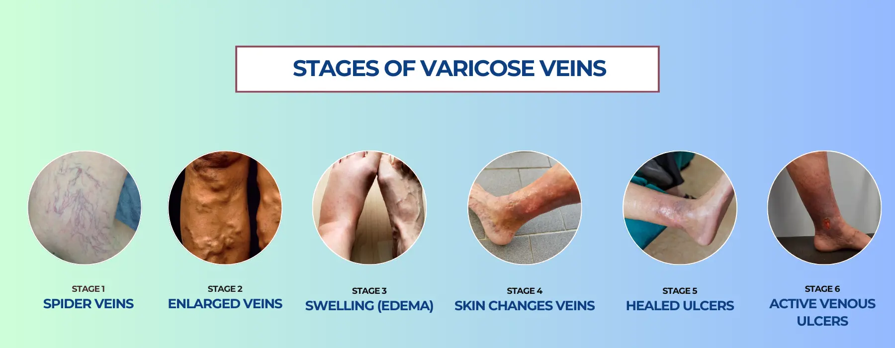 Stages of Varicose Veins