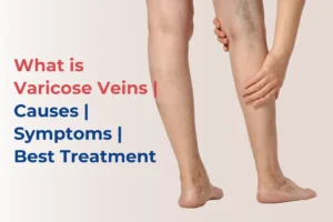 Varicose Veins