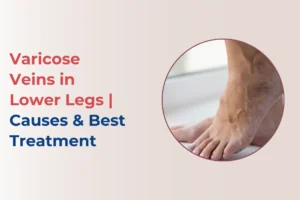 Varicose Veins in Lower Legs - best treatment