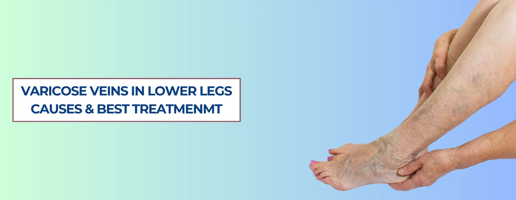 Varicose Veins in Lower Legs