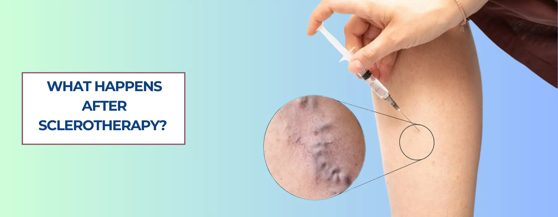 What Happens After Sclerotherapy