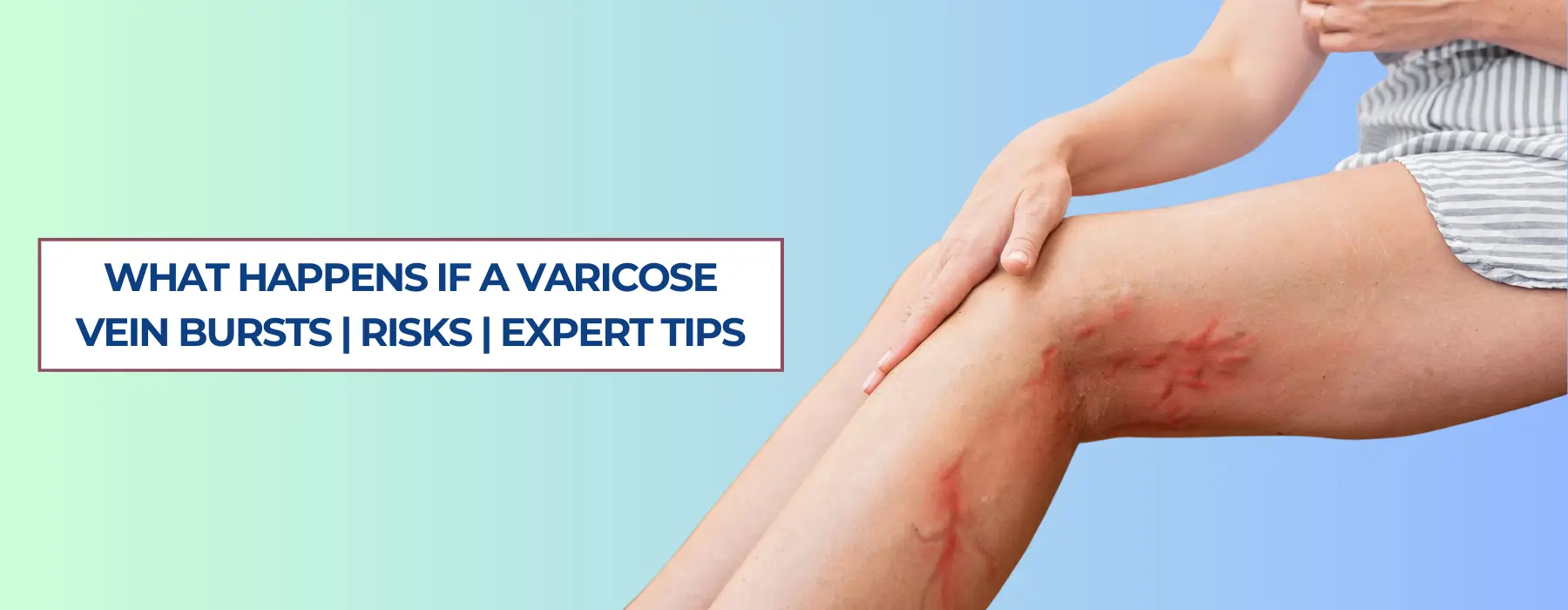varicose vein bursts